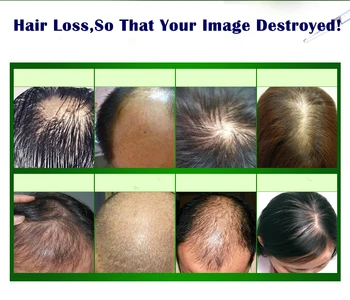 Dimollaure Hår Vækst anti hårtab Flydende 10ml tæt hårlag hurtigt sunburst hår vækst vokse alopeci Behandling olie essens